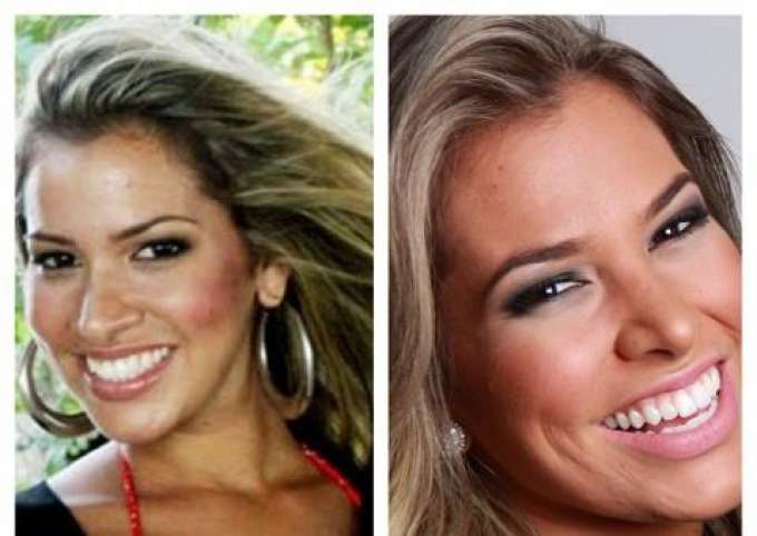 Ex-BBB Adriana mostra nariz antes e depois da cirurgia | Famosos & TV