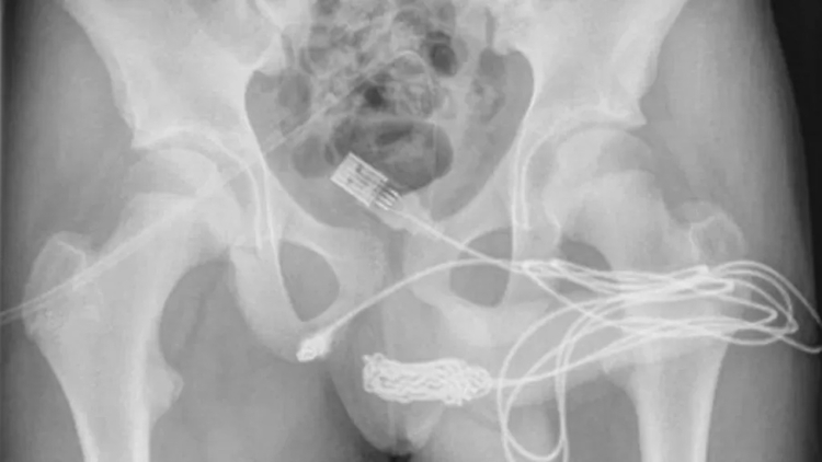 Imagem: Reprodução/Urology Case Reports