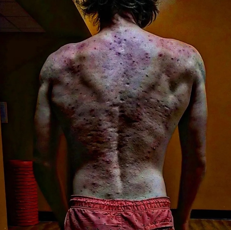 Johnathon mostra costas com quadro grave de acne após usar anabolizante. - Foto: Reprodução Instagram @john_joshua_james