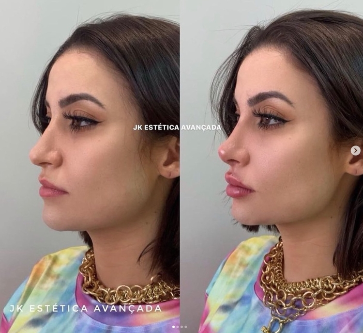 Veja antes e depois da harmonização facial de Bianca Andrade