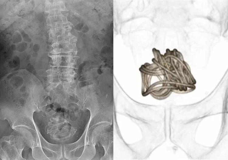 Foto: Reprodução/Urology Case Reports