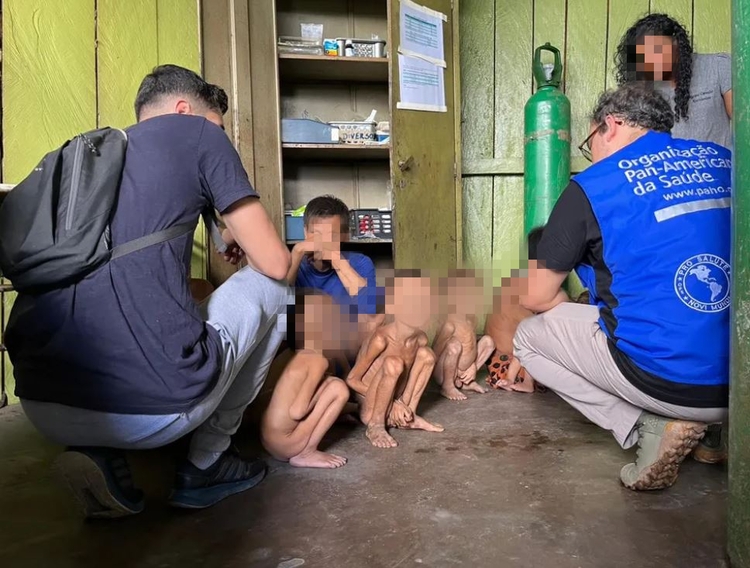 Crianças em situação de desnutrição - Foto: Condisi-YY/Divulgação