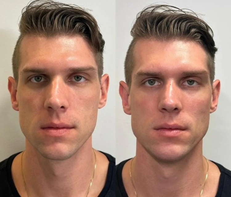 IInfluencer Bruno Diferente faz harmonização facial; veja resultado