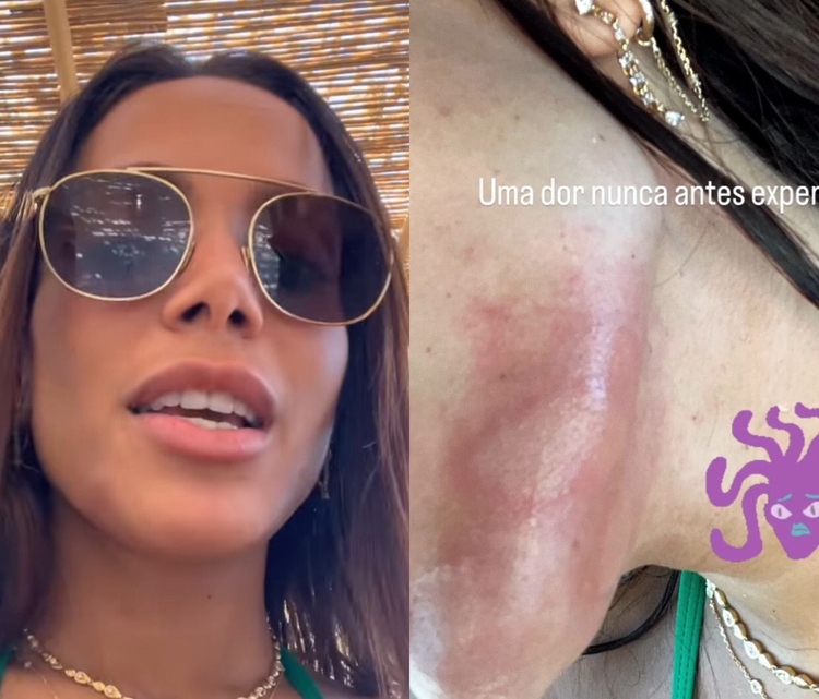 Anitta é queimada por água-viva em Ibiza - Imagens: Reprodução/Instagram