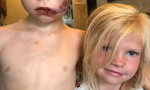 Menino arrisca a própria vida para salvar irmã de ataque de cão; rosto ficou desfigurado