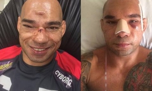 Lutador brasileiro tem crânio esmigalhado durante nocaute e passa por cirurgia de 7h