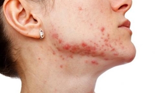 Com efeito cicatrizante, conheça planta que ajuda eliminar acnes 