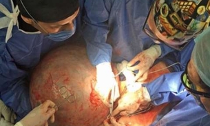 Médicos retiram cisto de 32kg de ovário de paciente 