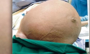 Mulher fica sem respirar por causa de tumor enorme de 27 kg na barriga; Veja