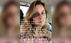 Brasileira agredida pelo namorado nos EUA faz alerta sobre relacionamento abusivo