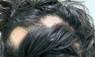 Entenda o que é Alopecia Areata, doença autoimune que provoca queda de cabelo