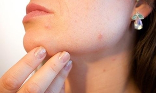 Aprenda a fazer hidratação na pele e evitar acnes