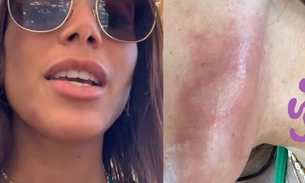 Anitta é queimada por água-viva em Ibiza - Imagens: Reprodução/Instagram
