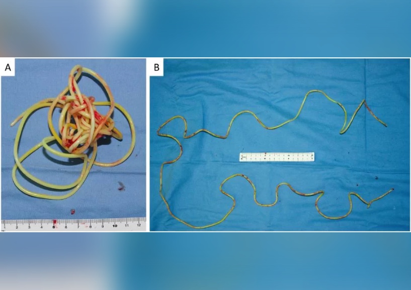 Foto: Reprodução/Urology Case Reports