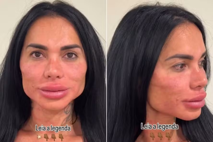 Kamila inchada após o procedimento para remoção do preenchimento labial. 