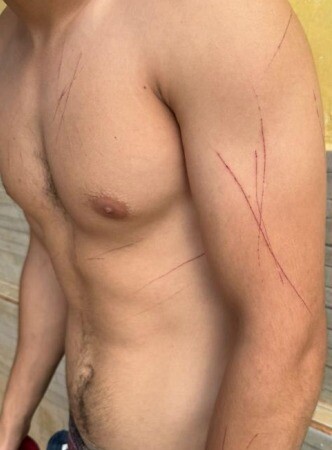 Vítima com marcas pelo corpo das torturas que sofria. - Foto: Divulgação PC-GO